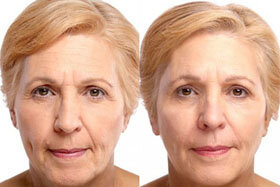 Figure 3 before and after application of Goji Cream