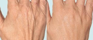 Skin of hands before and after fractional therapy