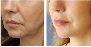 bio-strengthening of the face