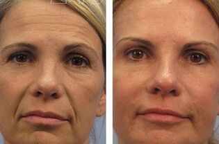 mesotherapy result
